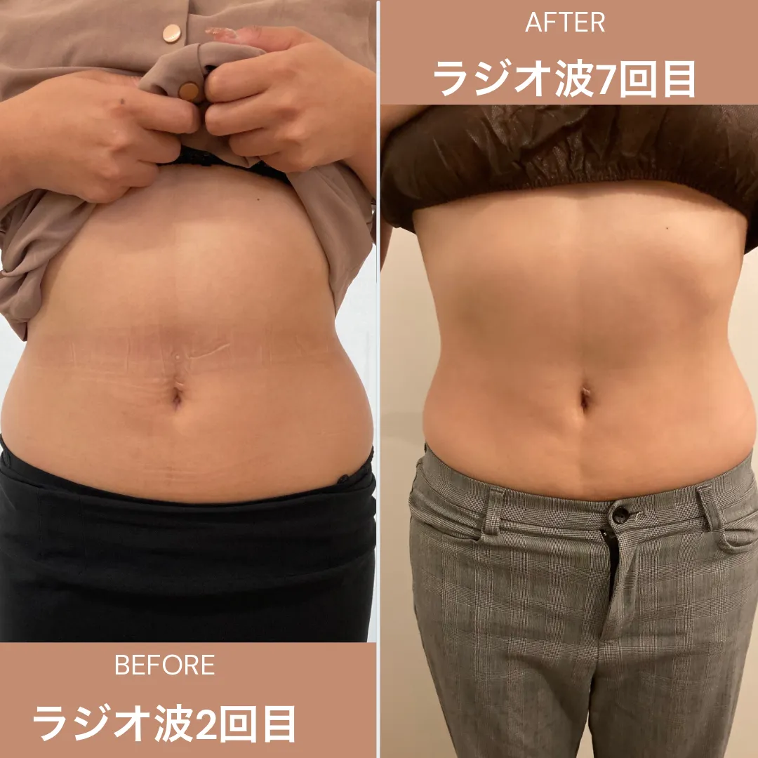 ラジオ波痩身✨💓