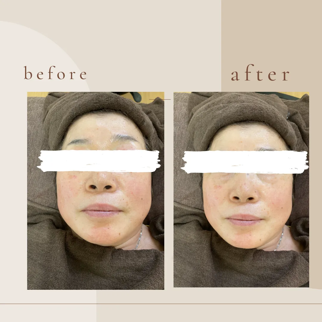 ラジオ波フェイシャル✨✨👩🏻👩🏻
